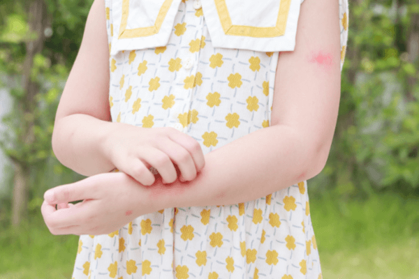 Little-Girl Scratching-Her-Arm Little girl scratching