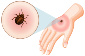 The Importance Of Preventive Pest Control 1 Bed bug bite
