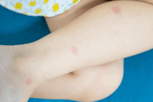 The Basics Of Bed Bug Pest Control In Utah 1 Insect bites on child leg