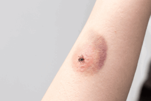 Pest Control In Utah: Complete Guide To Year-Round Pest Problems And Solutions 2 Tick bite on the arm