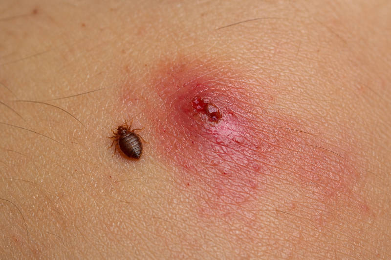 Brown bed bug next to a red, inflamed, bleeding bite on human skin.